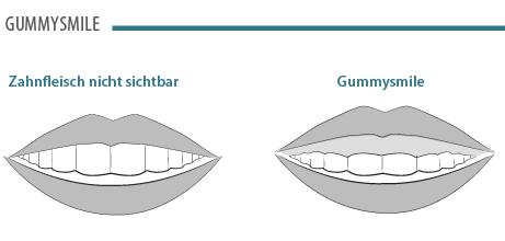 gummysmile.png 