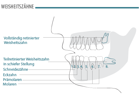 weisheitszaehne-01.png 